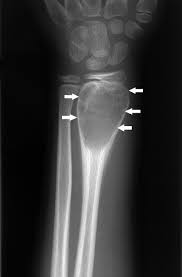 Tests For Musculoskeletal Disorders Bone Joint And Muscle Disorders Merck Manuals Consumer Version