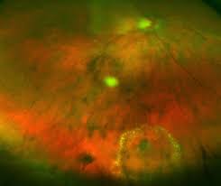 We did not find results for: Retinal Tear