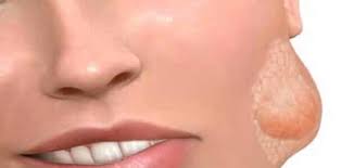 التهاب الغدد اللعابية المزمن معلومة ثقافية alaylalayl
