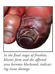 Frostbite stages and symptoms include burning, numbness, tingling, and itching of the skin. Frostbite