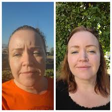 TOP 10 BEST Platelet Rich Plasma in Fontana, CA