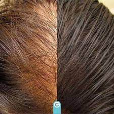 Orta Sac Cizgisinden Baslayan Kadin Tipi Androgenetik Alopesi Sac Ekimi Ile Sonsuza Dek Tedavi Edilebilir Detayli Bilgi Icin 90 8 Bracelets Jewelry Fashion