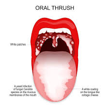 Image result for Oral thrush roof of mouth