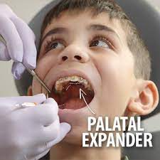 The Timely Use Of A Palatal Expander Could Help Correct A Cross Bite Demarco Family Dental