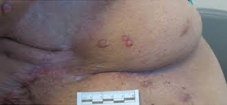 A cancer that's left untreated for many months or years can grow upwards and into the skin. Pruritic Nodules On The Breast Mdedge Dermatology