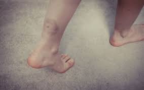 Prellung Kontusion Das Hilft Bei Einer Prellung Onmeda De