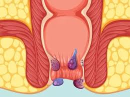 Image result for Hemorrhoid