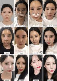 Find useful and attractive results. A Complete Guide To Wide Nose Rhinoplasty Nose Jobs For Wide Noses