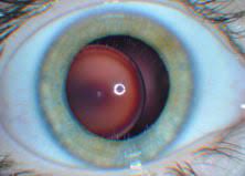 Ecps Can Play Vital Role In Diagnosis Of Marfan Syndrome