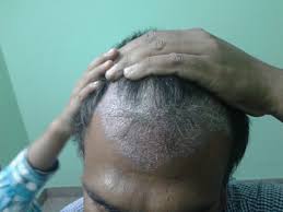 Add bath oil, colloidal oatmeal and epsom salts to the water and soak for at least 15 minutes. Ayurvedic Treatment For Scalp Psoriasis Psoriasis Treatment Bangalore