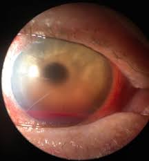 Image result for Hyphema