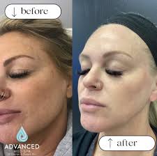 The power of a peel ✨🌟 We are LOVING these results from our VI Peel. These  results are after just ONE treatment. And for the month of September we  have a Buy