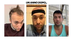 La migliore clinica per trapianto di capelli in turchia. 1 Anno Dal Trapianto Di Capelli In Turchia La Mia Trasformazione Trapianto Capelli Hair Transplan Youtube