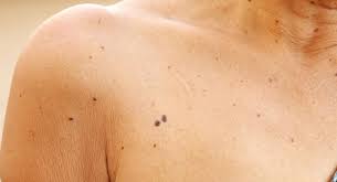 É um dos tipos de verruga e normalmente cresce em volta das unhas, nos dedos e mão. Verrugas En Adultos Mayores Que Son Causas Y Como Eliminarlas