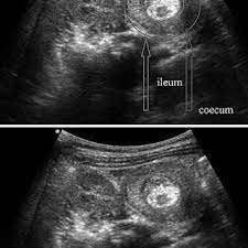 Abdominal Ultrasound Target Sign Of An Ileocecal Intussusception In Download Scientific Diagram