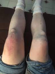If these are the problem(s) that you are dealing with, we've got it all covered in the next section. Living With Bilateral Quadriceps