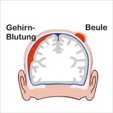 Gehirnerschutterung Bei Babys Und Kindern