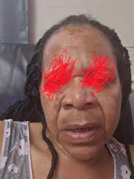 Hi guys what home remedies can I use to remove dark spots and pimples  please help guys my face is a disaster