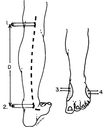 Image result for Perthes Test