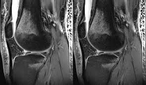 «mri component in the shape of a glove delivers the first clear images of bones, tendons and…» Https Cdn0 Scrvt Com 39b415fb07de4d9656c7b516d8e2d907 1800000004389981 6c544b9a5eff Magnetom Flash 69 Rsna 04389981 1800000004389981 Pdf