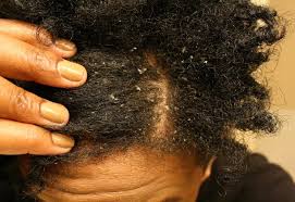 I recommend using a bristle brush. Get Rid Of Dandruff On Natural African Hair 4c Hair Black African Hair