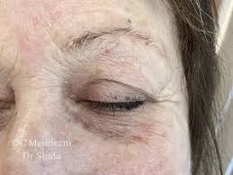 Image result for xanthelasma of eyelid