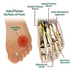 Morton S Neuroma Physiopedia