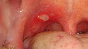 Image result for Physical injury red spots roof of mouth
