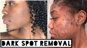 If you are fed up with dark spots? Skin How To Get Rid Of Dark Scars Hyperpigmentation Acne Scars At Home No Click Bait Youtube