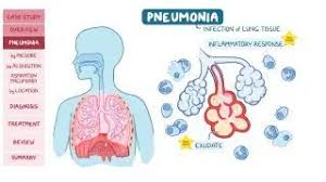 Image result for Pneumonia