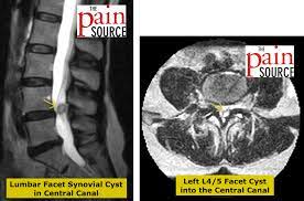 Lumbar Facet Syndrome Icd 10 Back Pain Powerpoint Ppt Unveiling