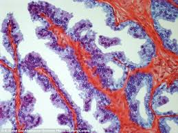 He has a family history of prostate cancer in a father and brother. Prostate Cancer Kept At Bay By Aspirin Prostate Cancer Foundation Of New Zealand
