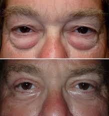 Check spelling or type a new query. 11 Ways To Get Rid Of Puffy Eyes Fast After Crying In The Morning Etc