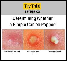 How To Pop A Pimple 5 Simple Ways To Pop A Pimple Beauty Tips Pimplespopping Pimples Face Skin Care Anti Itch Cream
