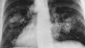 Boli de plamani si afectiuni asociate. Cancerul Bronhopulmonar La Plamani Simptome Investigatii Diagnostic