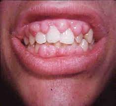 Bleeding Gums What Does It Mean Docklands Dental Blog