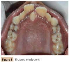 Mesiodens is a common clinical finding among children and has a higher prevalence in asian populations. Management Of Palatally Positioned Impacted Mesiodens 2 Case Reports Insight Medical Publishing