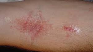 Image result for contact dermatitis