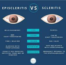 Image result for Scleritis
