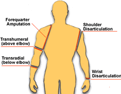 Upper Limb Amputations Capital Health Physical Therapist Assistant Fitness Motivation Physical Therapy