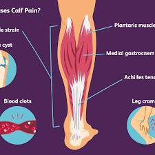 Information from webmd on tendon ruptures, a potentially serious problem that may result in excruciating pain and permanent disability if a tendon is the fibrous tissue that attaches muscle to bone in the human body. Calf Pain Causes Treatment And When To See A Doctor