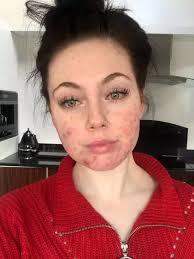 Teacher who nearly quit her job because of severe acne uses social media to  help others