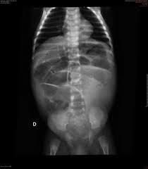 Image result for Megacolon