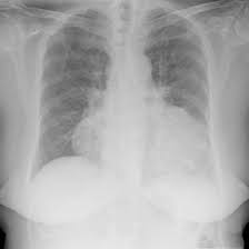 Ischemic Heart Disease Chf Mortality Vary Across Va Systems Clinical Advisor