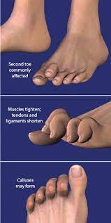 If left too long, the toe can become fixed in its position and can become. Fix Your Feet Claw Toe