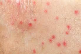 Bonjour, j'ai des boutons rouges, apparus en premier sur les poignets, qui piquent et qui se propagent sur toute la main (droite comme de gauche) puis maintenant se dirigent vers le coude. Eruption Boutons Lesions De La Peau Symptomes Traitement Definition Docteurclic Com