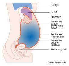 Maybe you would like to learn more about one of these? Ascites Fluid Tapping Askintensivist
