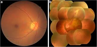 Retinal detachment is a condition in which the neurosensory retina is separated from the retinal pig­ment epithelium. A Case Of Tractional Retinal Detachment Associated With Congenital Retinal Vascular Hypoplasia In The Superotemporal Quadrant Treated By Vitreous Surgery Bmc Ophthalmology Full Text