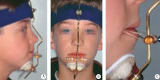 TRATAMENTO DA MORDIDA CRUZADA ANTERIOR: REVISÃO DE LITERATURA RESUMO
