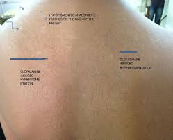 Dermoscopy of granulomatous conditions is well documented. Borderline Tuberculoid Leprosy With Type 1 Reversal Reaction Bmj Case Reports